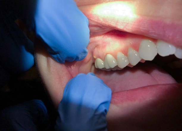 Best Emergency Wisdom Teeth Removal in Ball, LA